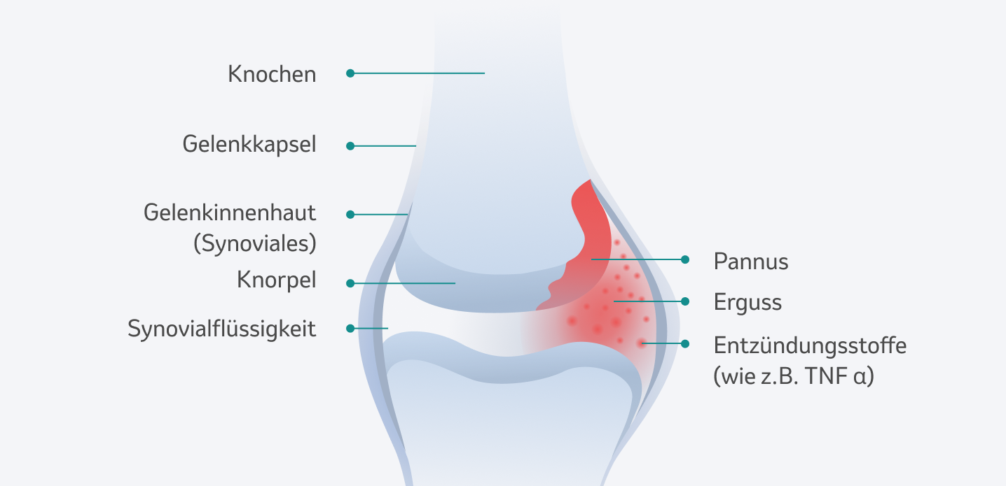 Was Ist Psoriasis Arthritis Msd Gesundheit Schweiz